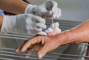 doctor caring for wound after debridement