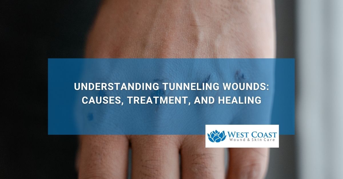 Understanding Tunneling Wounds Causes, Treatment, and Healing ()