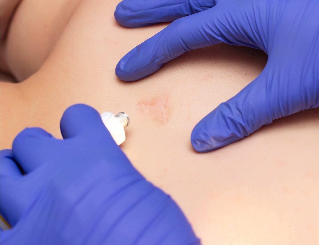 Wound Care For Scar Healing, Treatment and Prevention