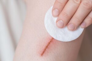 specialist caring for a wound to prevent scarring