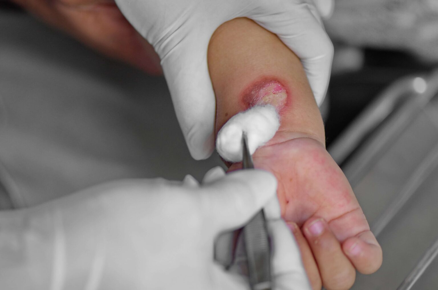 How to Care for a Burn Wound? A Guide to Healing Burns