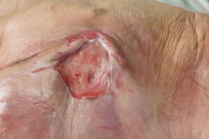 stage two pressure ulcer wound