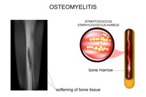 showing how bacteria infection causes osteomyelitis