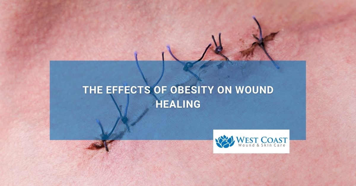 The Effects of Obesity on Wound Healing