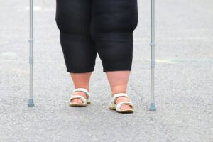 obese woman healing from a wound