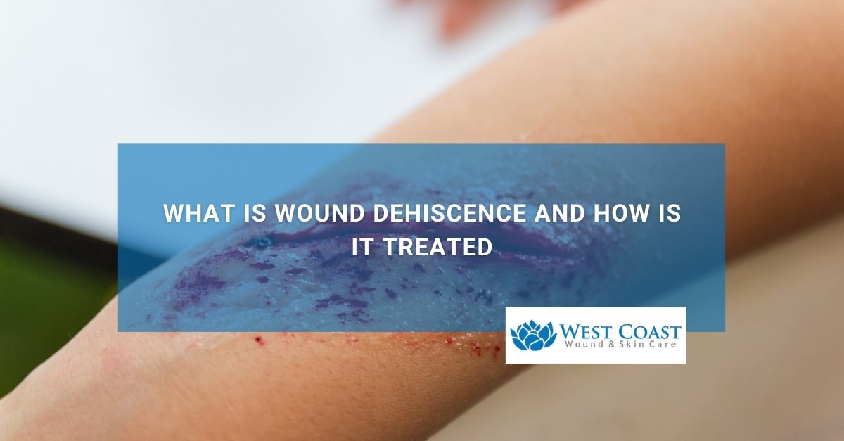 What is Wound Dehiscence and How Is It Treated