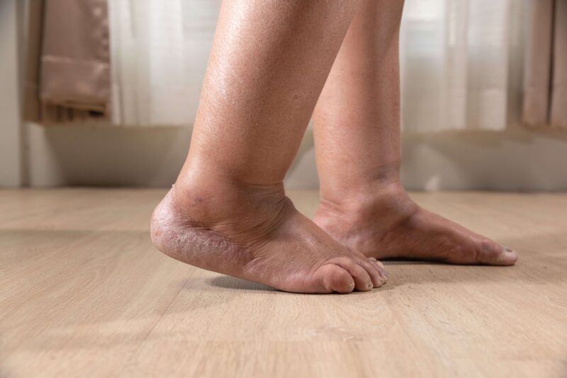 Leg Edema Causes, Treatment & Its Impact on Wound Care