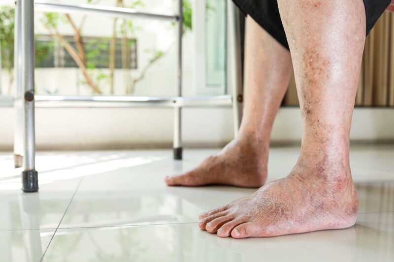 Leg Edema Causes, Treatment & Its Impact on Wound Care