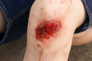 open wound on a person’s knee