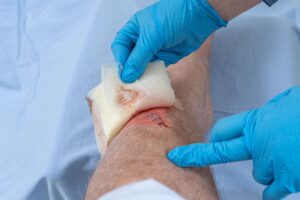 doctor applying moist wound dressing to injury