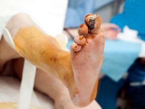 man in treatment for diabetic gangrene