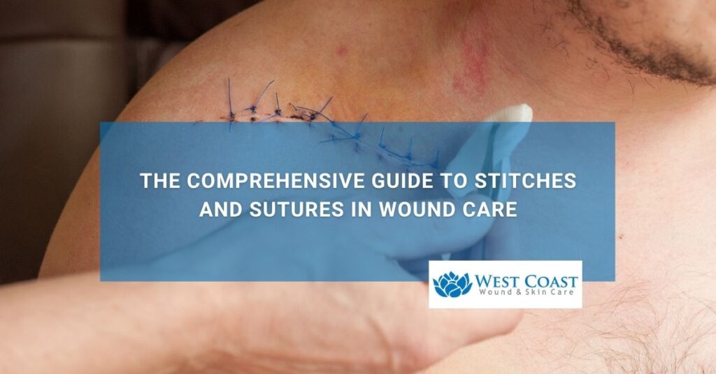 The Comprehensive Guide to Stitches and Sutures in Wound Care
