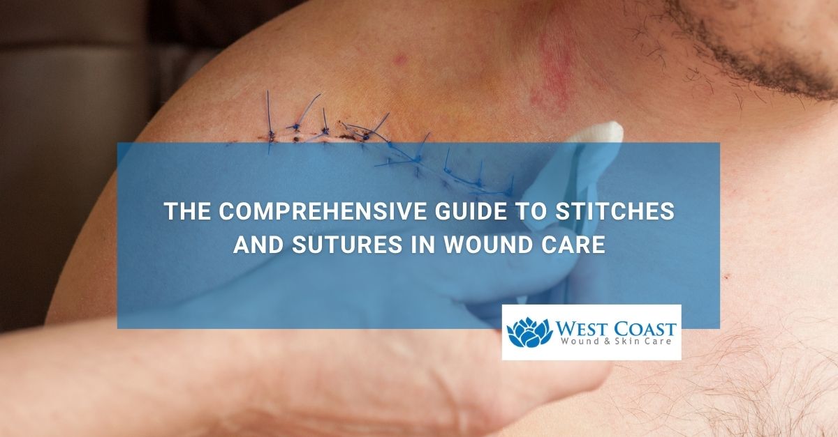 The Comprehensive Guide to Stitches and Sutures in Wound Care