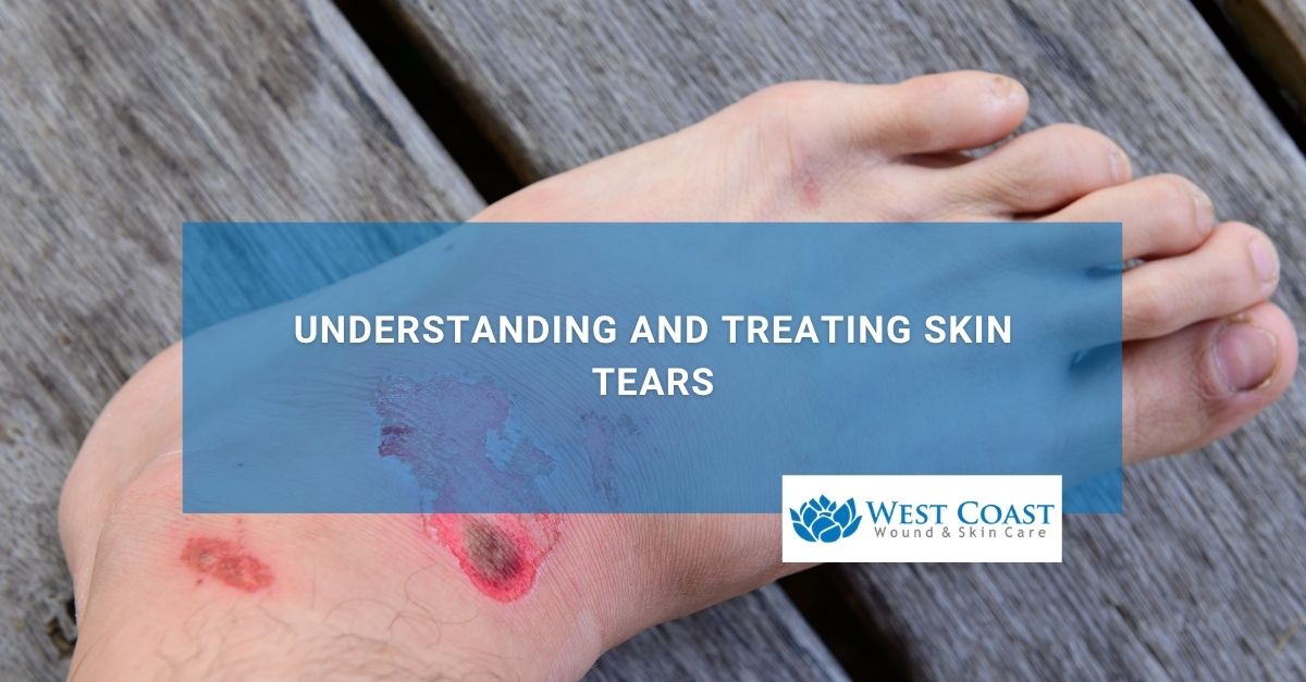 Understanding and Treating Skin Tears