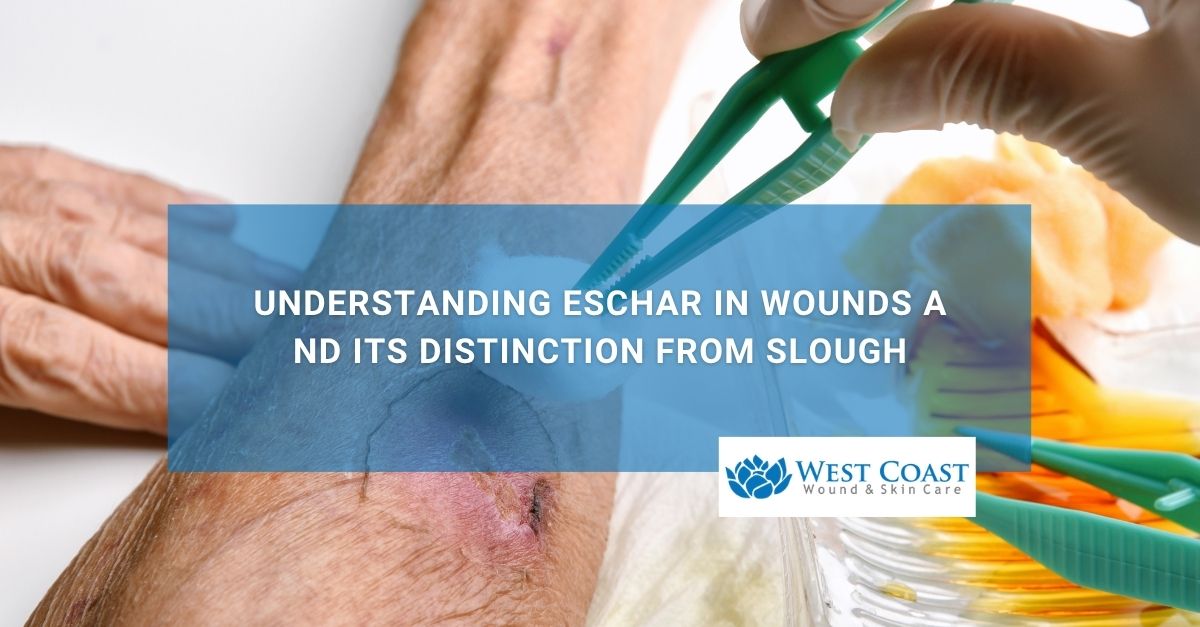 Understanding Eschar in Wounds and Its Distinction from Slough