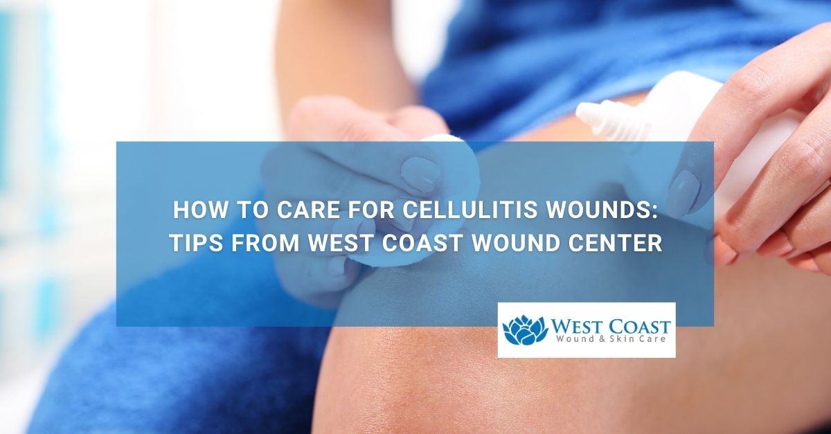 How to Care for Cellulitis Wounds Tips from West Coast Wound Center