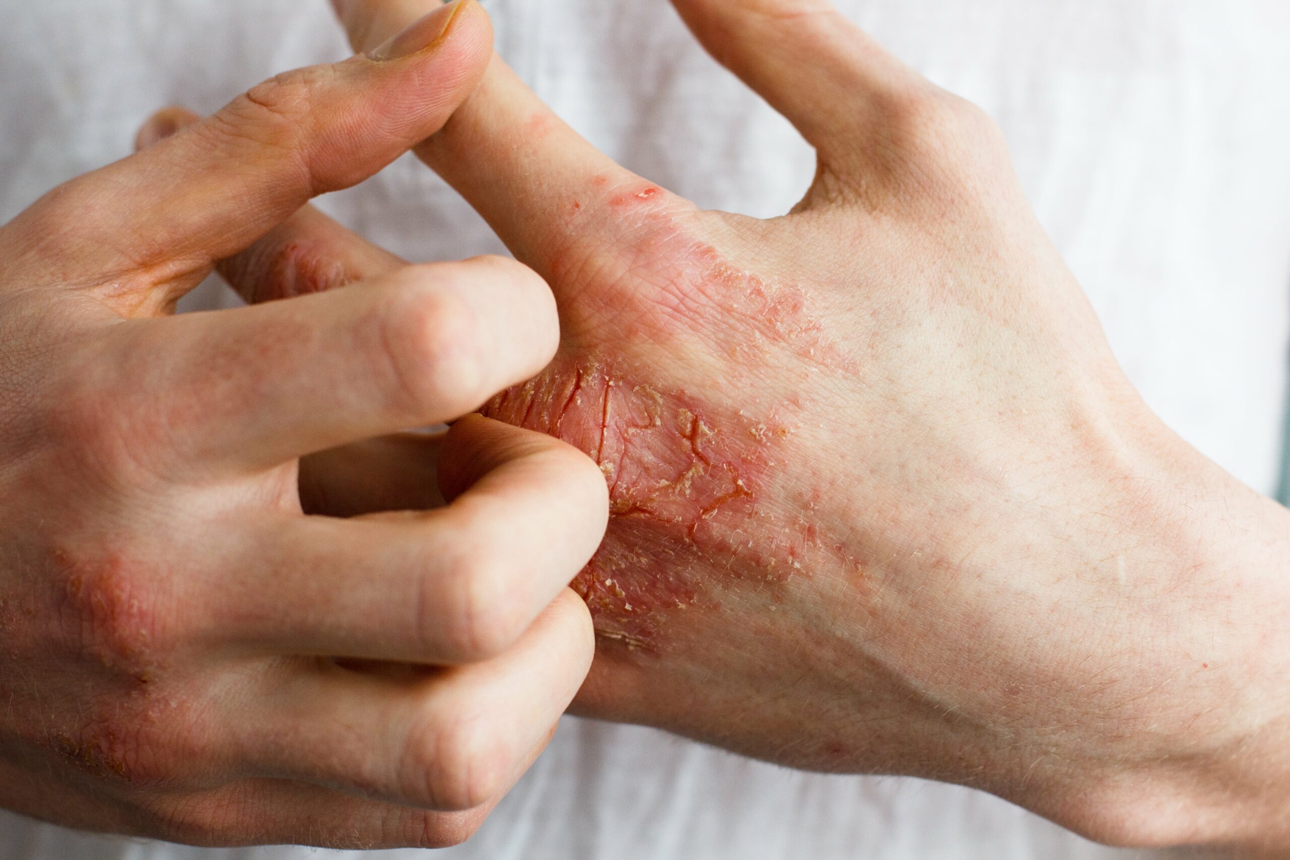 hand scratching a healing wound