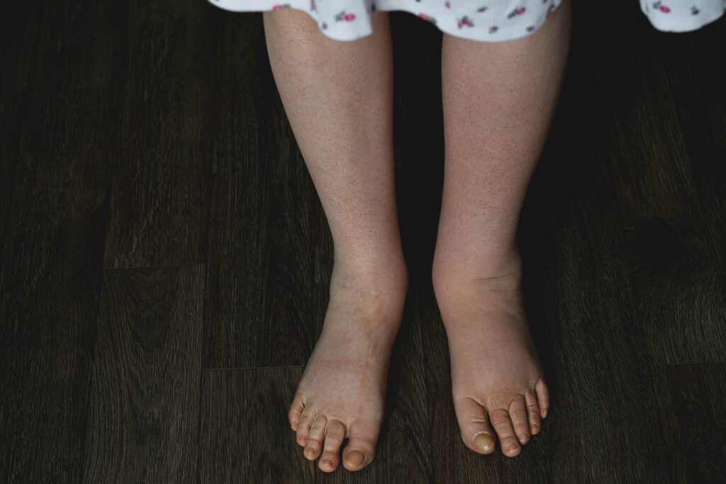 woman with lymphedema in her leg