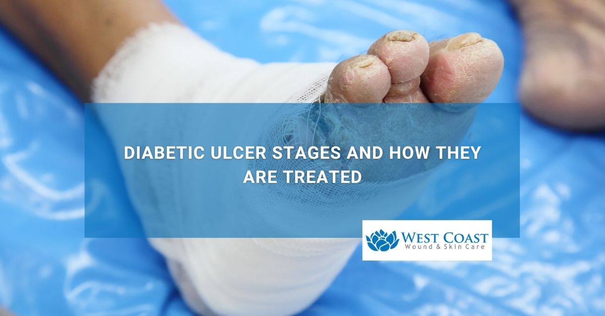 Diabetic Ulcer Stages and How They Are Treated