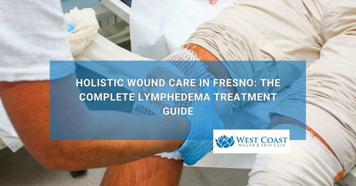 Holistic Wound Care in Fresno The Complete Lymphedema Treatment Guide