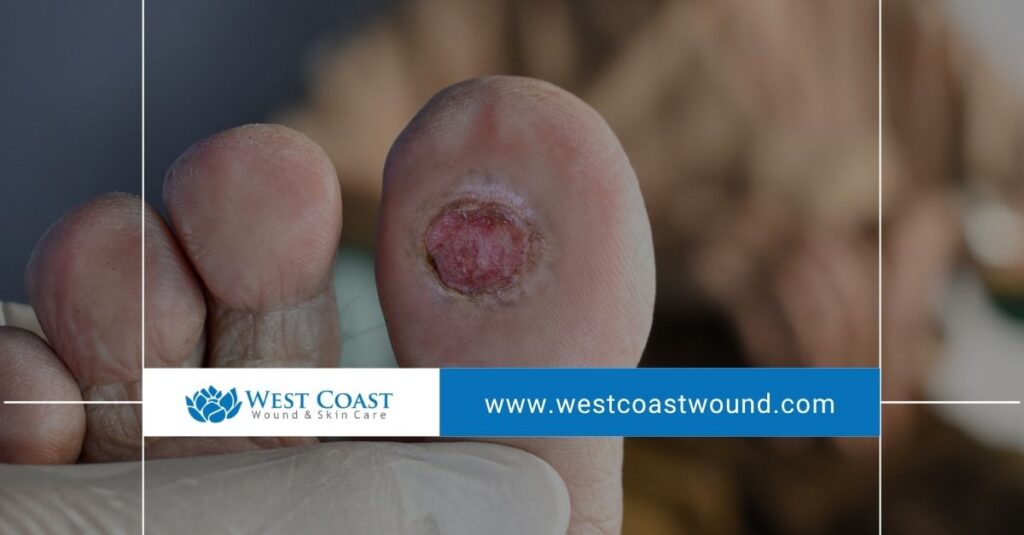 pressure ulcer wounds