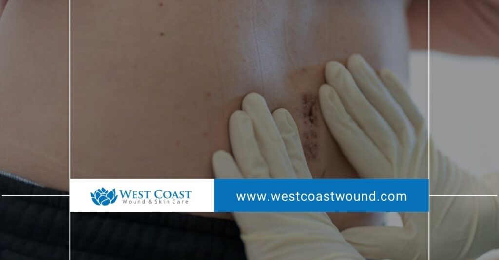 Surgical wounds that heal slowly
